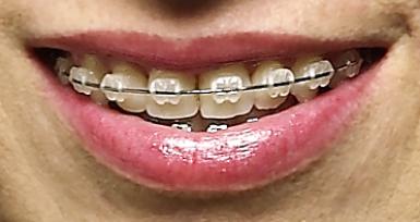 All About Orthodontic Arch Wires - ArchWired