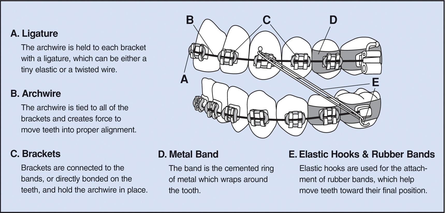 All About Orthodontic Arch Wires - ArchWired